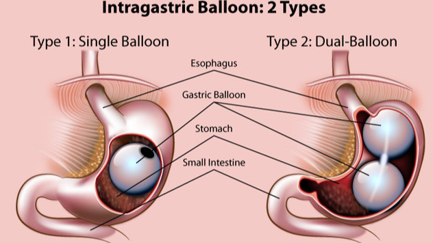 Gastrik balon